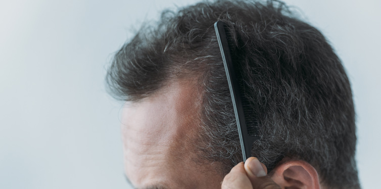 hair loss concept