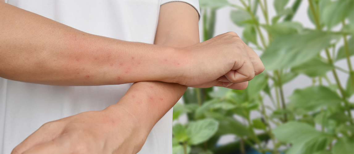 10 Best Ways To Treat Mosquito Bites Gear Hungry