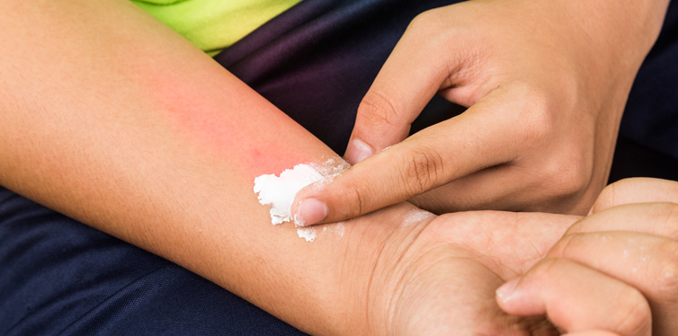 treating mosquito bites